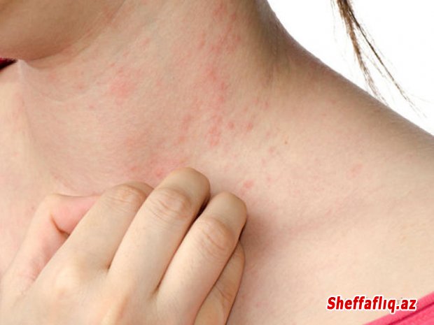 Allergiya-immun sisteminin adətən zərərsiz maddələrə belə göstərdiyi kəskin reaksiyadır.